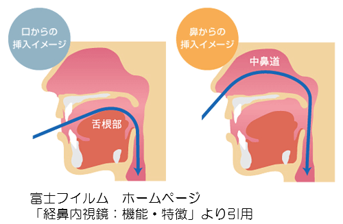口からの挿入イメージ、鼻からの挿入イメージ